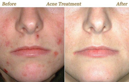 Most Expensive Acne Treatment